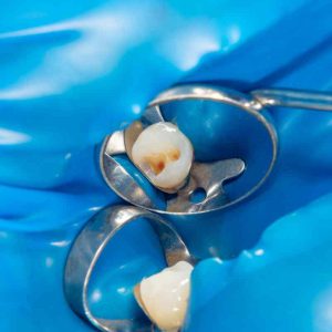 Endodoncia